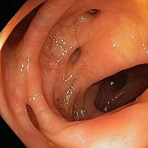 Bowel disease in the colon C016 / 8338