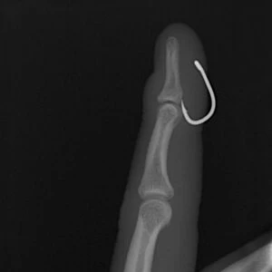 Fish hook in finger, X-ray C017 / 7160