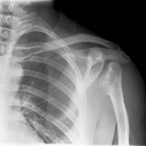 Septic arthritis, X-ray C017 / 7385