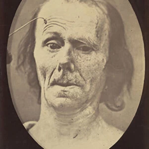 Figure 9: A study of m. frontalis in maximum contraction, 1854-56, printed 1862